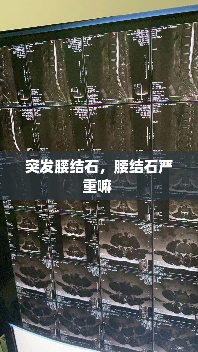 突发腰结石,腰结石严重嘛